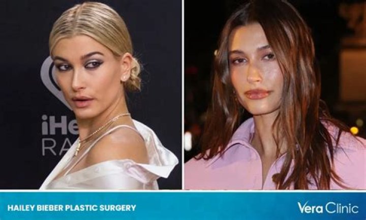 Rumors on Hailey Bieber’s Plastic Surgery — Threatened to Sue a Surgeon